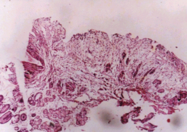 Fig.3: Regresión pos-terapia de un caso MZL-MALT - <div style=